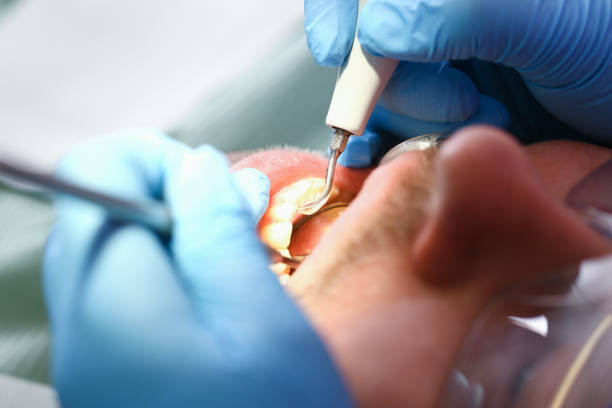 Best Emergency Wisdom Teeth Removal in Sewaren, NJ